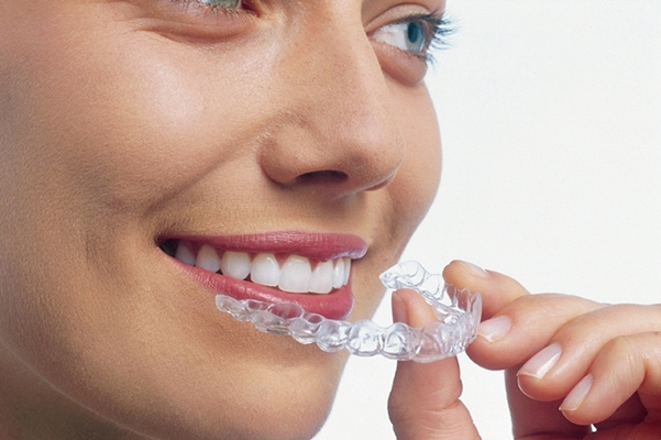 インビザライン