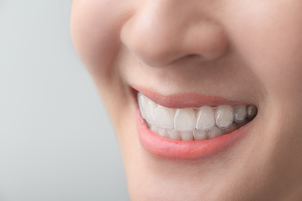 あなたの「進歩」に合わせたマウスピースを