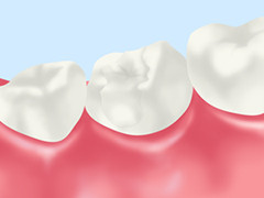 オールセラミッククラウン（奥歯用）