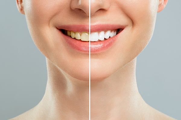 白く輝く歯を手に入れる「ホワイトニング」