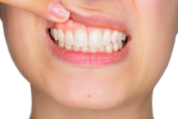 透明感のあるピンク色の歯茎は「ガムピーリング」で手に入れる