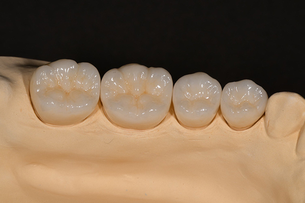 「やってよかった」と思っていただけるワンランク上のセラミック治療