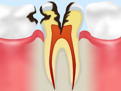 C3：歯の神経に達したむし歯