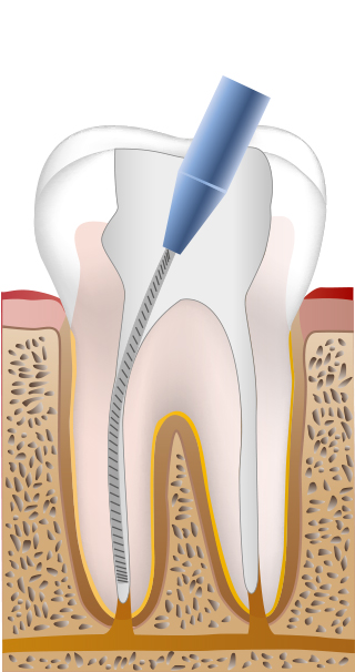 STEP1 歯の内部から神経を除去し、根管の長さを測ります。