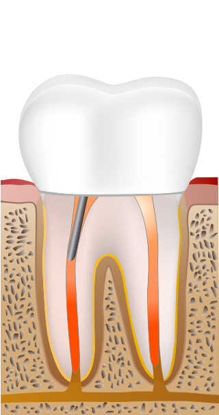 STEP5 支台を取り付け、被せ物を装着して歯の機能を回復します。