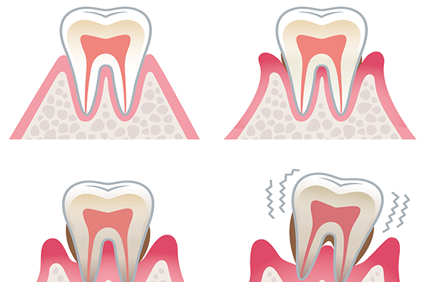 歯を失う病気の第一位「歯周病」