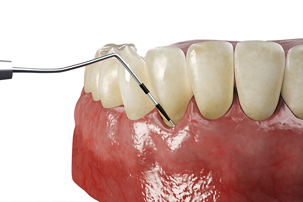 老後の残存歯数を左右するのは、「今」の歯周病治療。